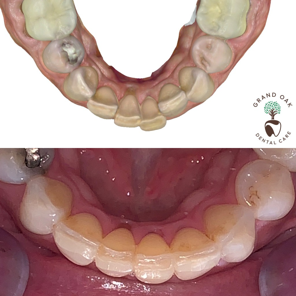 Aligning Lower Crowded Teeth